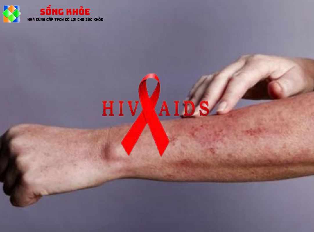 Dấu hiệu sớm mắc HIV
